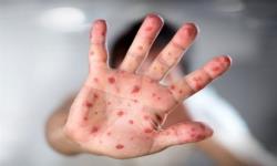 تأیید رسمی حذف سرخک و سرخجه در ایران توسط سازمان جهانی بهداشت