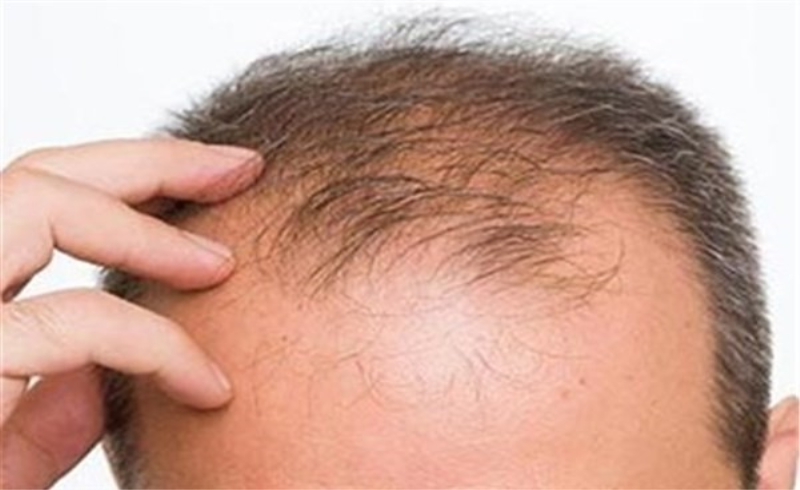 علت ریزش مو در مردان چیست؟